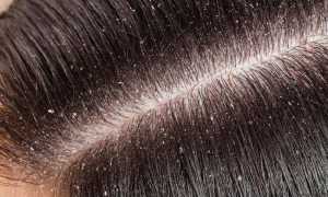 Почему чешется голова и выпадают волосы, как это исправить