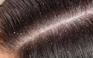 Почему чешется голова и выпадают волосы, как это исправить