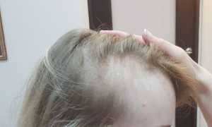 Выпадают волосы после родов: причины, что делать?