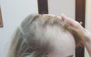 Выпадают волосы после родов: причины, что делать?