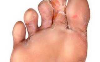 Трещины между пальцами ног: возможные причины и методы лечения