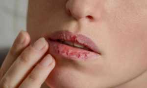 Сохнут губы: основные причины и лучшие рецепты
