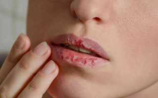 Сохнут губы: основные причины и лучшие рецепты