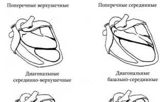 Дополнительная хорда в сердце