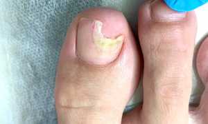 Почему ноготь отходит от ногтевого ложа на ноге: диагностика и лечение