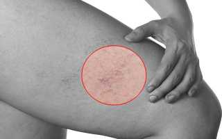 Белые пятна на ноге – частичная пигментация кожи