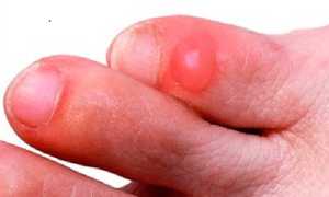 Как правильно удалить мозоль на мизинце ноги в домашних условиях?