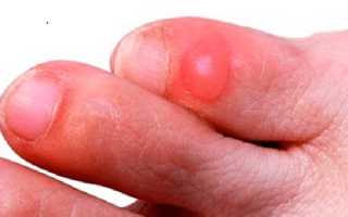 Как правильно удалить мозоль на мизинце ноги в домашних условиях?