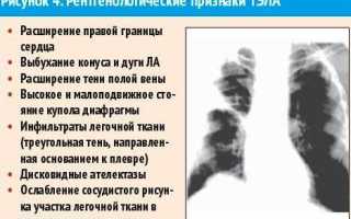 Тромбоэмболия легочной артерии последствия