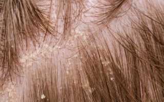 Почему чешется голова: лечение препаратами и народными средствами