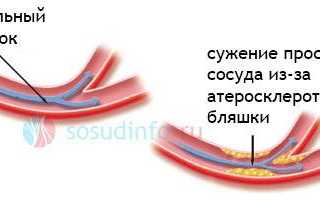 Лечение бляшки в сонной артерии