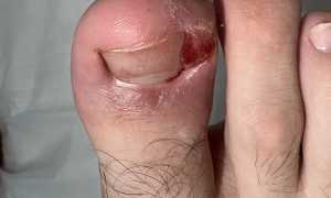 Как лечить вросший ноготь на большом пальце ноги