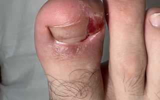 Как лечить вросший ноготь на большом пальце ноги