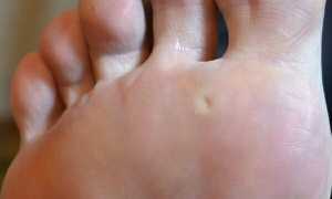 Как можно вылечить стержневую сухую мозоль в домашних условиях