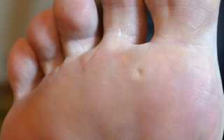 Как можно вылечить стержневую сухую мозоль в домашних условиях