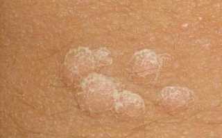 Как быстро избавиться от папиллом в домашних условиях: лучшие средства