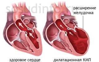 Метаболическая кардиомиопатия что это такое