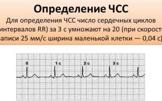 Как выглядит кардиограмма здорового человека