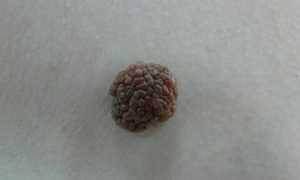 Образования на коже, похожие на бородавки: причины, методы лечения