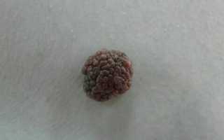 Образования на коже, похожие на бородавки: причины, методы лечения