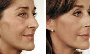 Биоревитализация лица: показания и эффективность процедуры