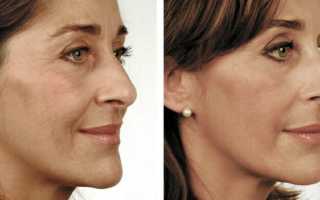 Биоревитализация лица: показания и эффективность процедуры