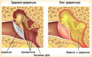 Компресс на ухо – предупреждение развития острого отита