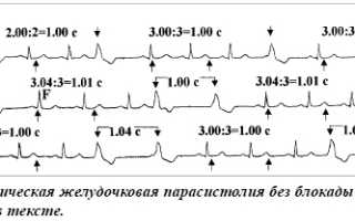 Желудочковая парасистолия