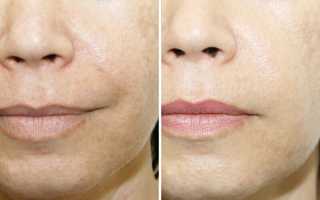 Мезотерапия лица: описание, отличия от биоревитализации, противопоказания
