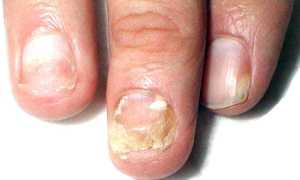 Онихомикоз ногтей: симптомы и способы лечения