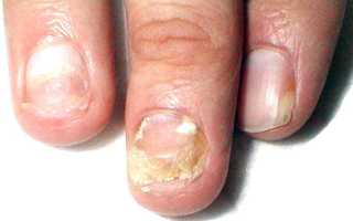Онихомикоз ногтей: симптомы и способы лечения