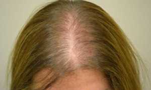 Выпадение волос у женщин после 40 лет: причины и лечение