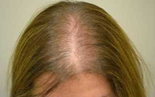 Выпадение волос у женщин после 40 лет: причины и лечение
