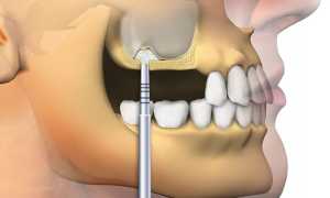 Зачем нужно делать синус-лифтинг: разновидности и противопоказания