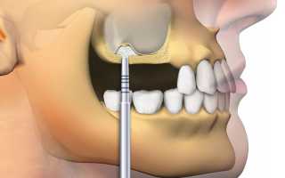 Зачем нужно делать синус-лифтинг: разновидности и противопоказания