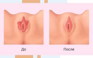 Интимная пластика — в каком случае она неободима?