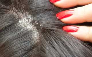Как быстро и эффективно избавиться от перхоти