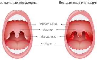 Миндалины — когда на них стоит обратить внимание?