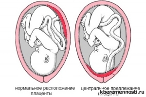 Фото по теме Центральное предлежание плаценты